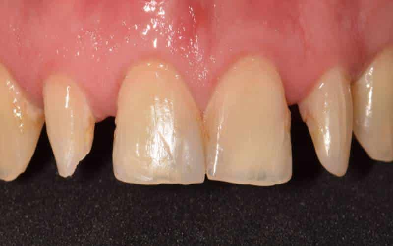 Diasztéma zárás avagy a fogköz eltüntetése előtt