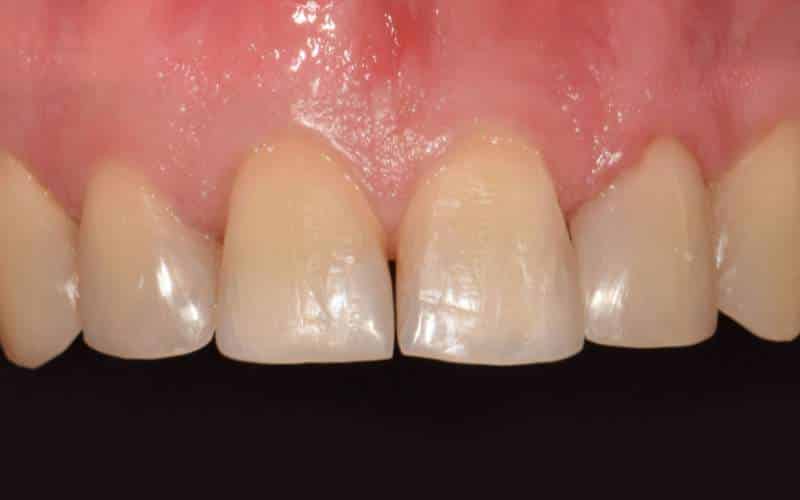 Diasztéma zárás avagy a fogköz eltüntetése után
