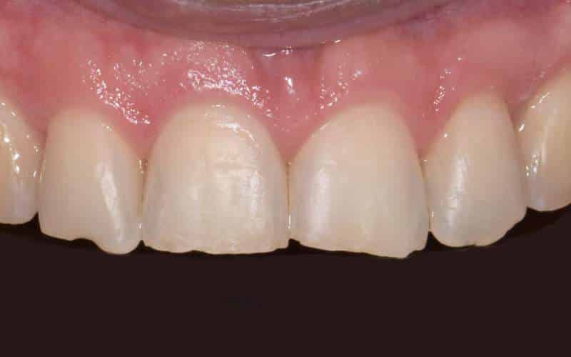 Élpótlás előtt és után (felső fogsor)