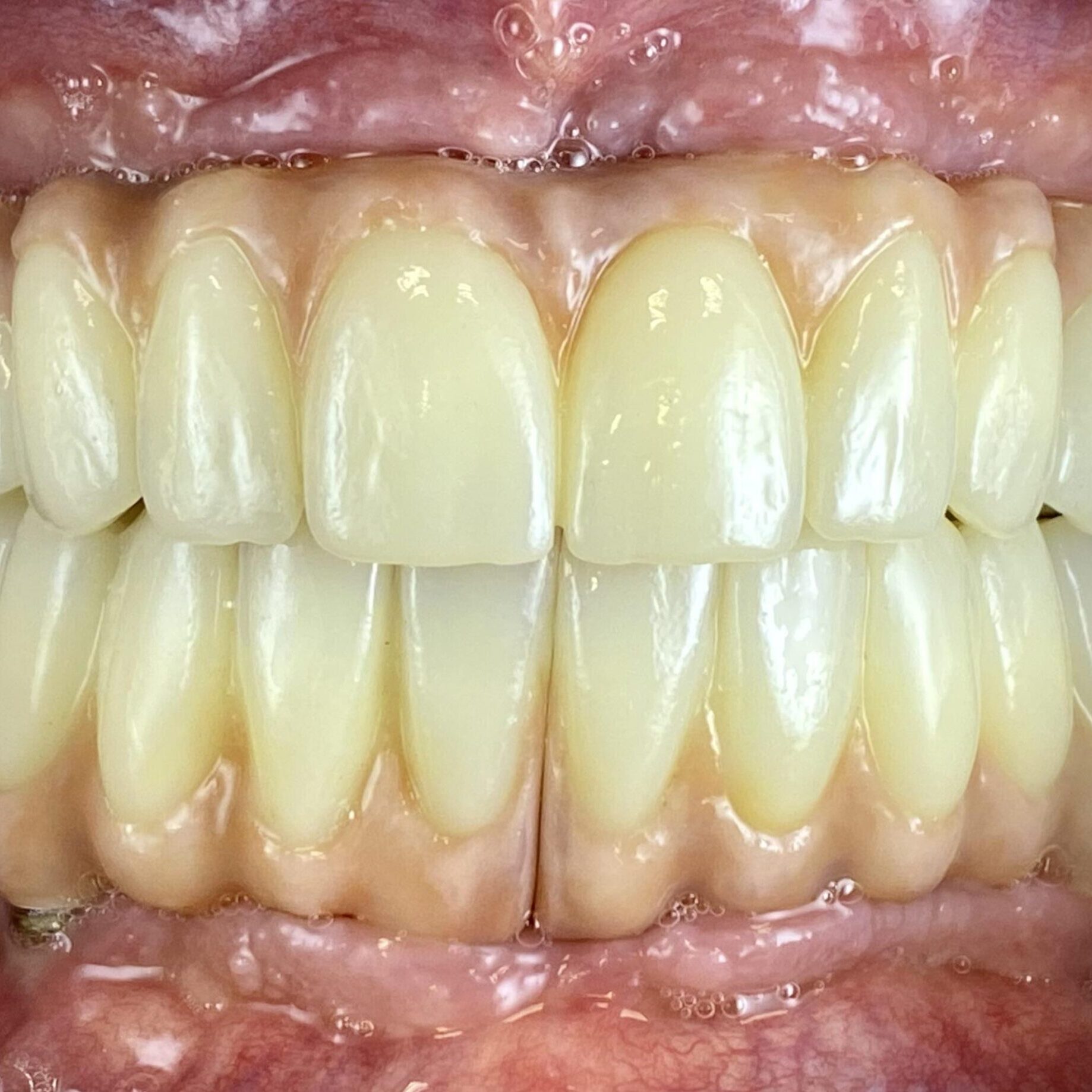 Súlyosan károsult fogsor teljes cseréje után