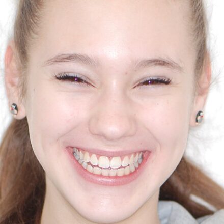 Gyermek fogszabályozás után