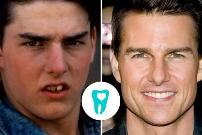 Híresség fogszabályozás előtt és után