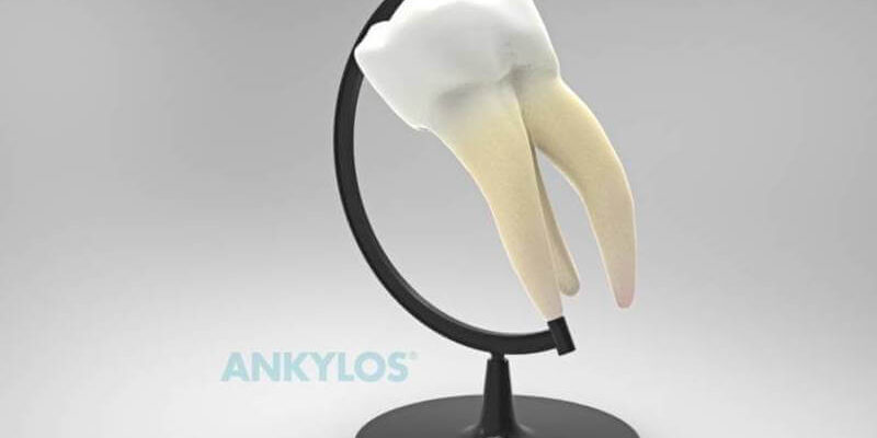 Ankylos fogimplantátumok Ankylos fogimplantátumok