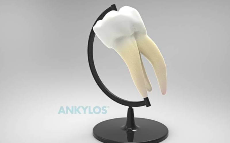 Ankylos fogimplantátumok