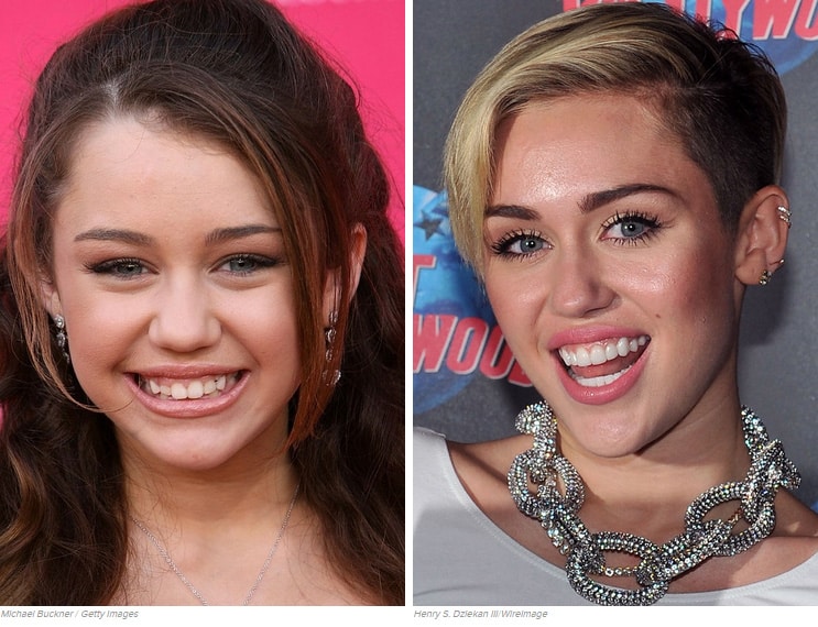 Miley Cyrus fogszabályozás előtt és után