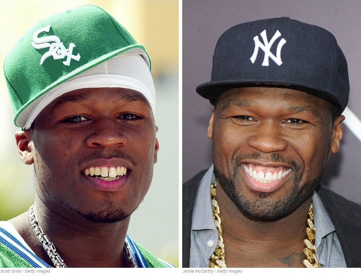 50 Cent fogszabályozás előtt és után