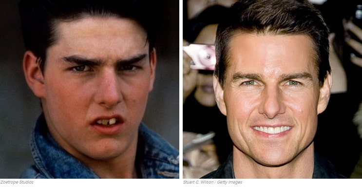 Tom Cruise fogszabályozás előtt és után