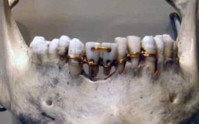 Ókori fogszabályozás