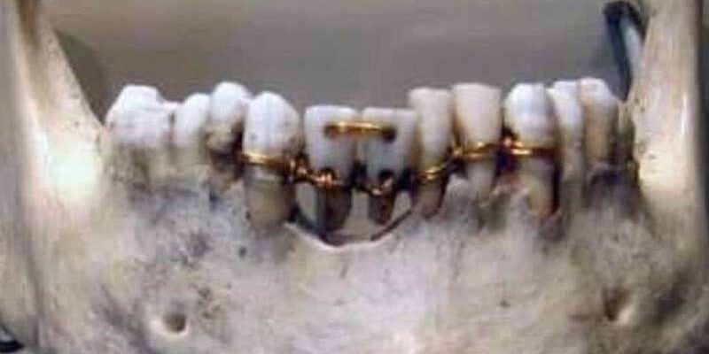 Ókori fogszabályozás Ókori fogszabályozás