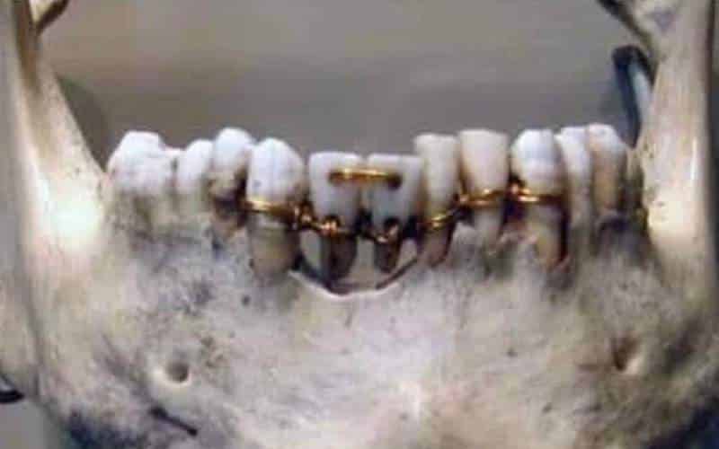 Ókori fogszabályozás