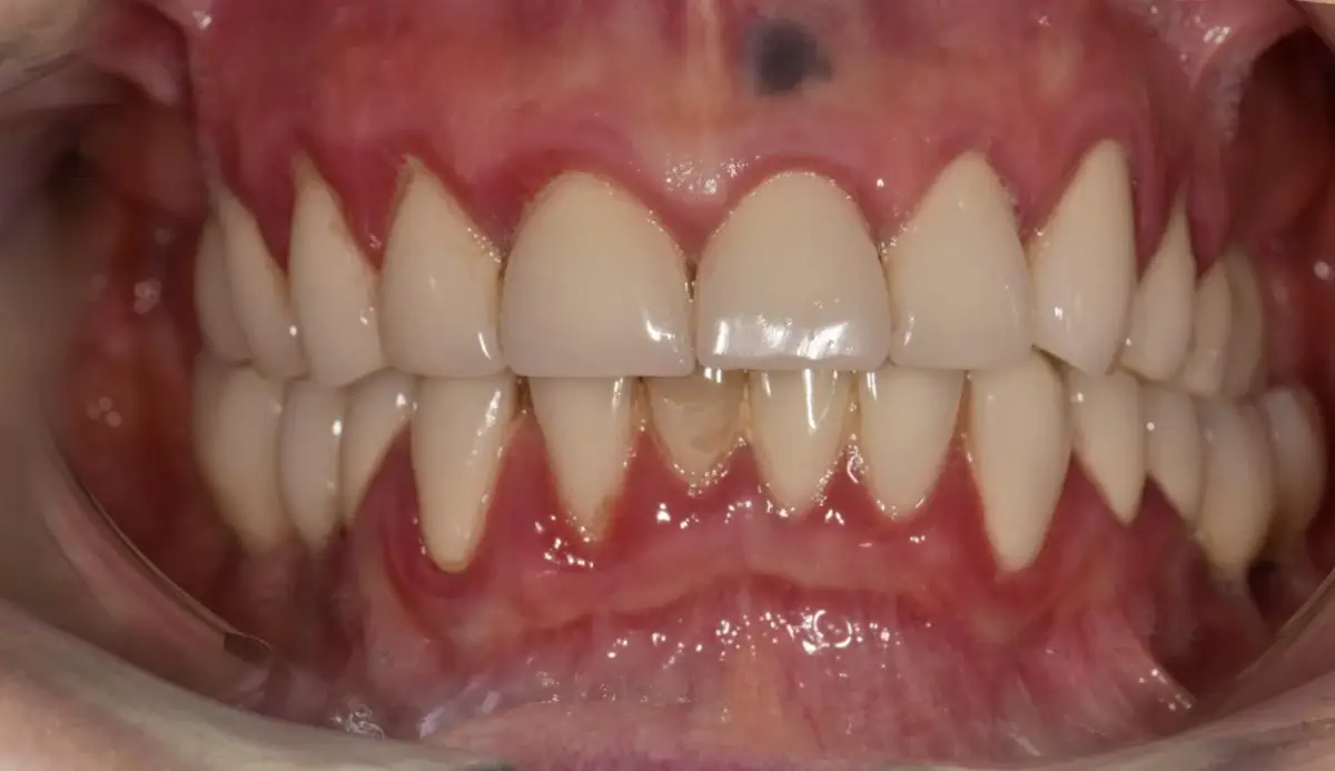Fogínygyulladás állapotában lévő fogsor, beavatkozás előtt