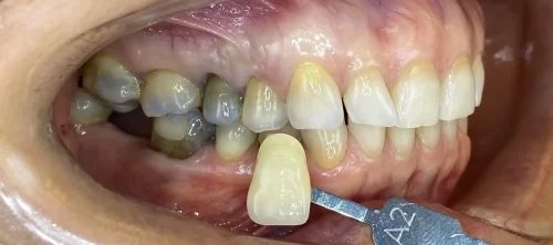 Esztétikus kezelés előtt