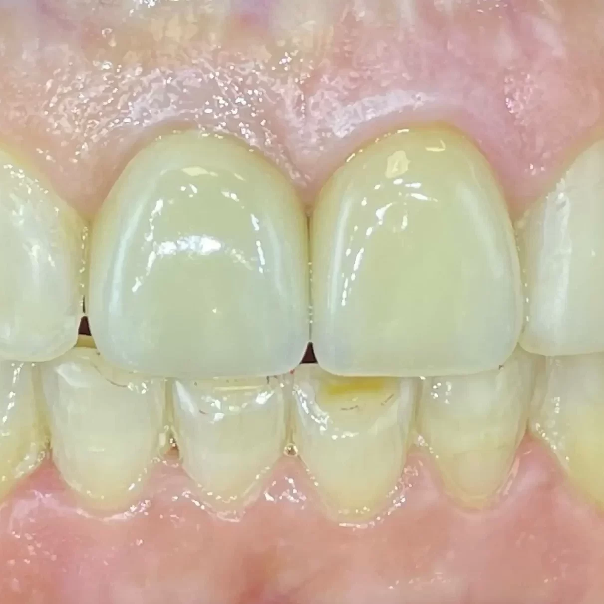 Azonnali implantáció