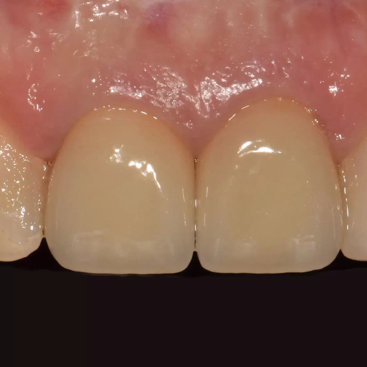 Azonnali implantáció