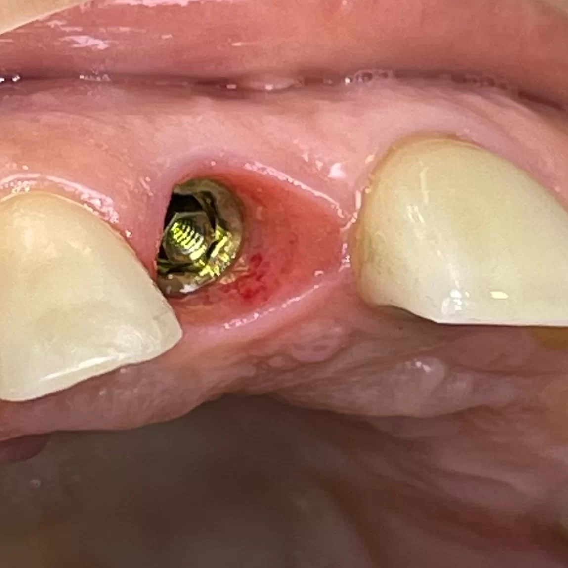 Azonnali implantáció