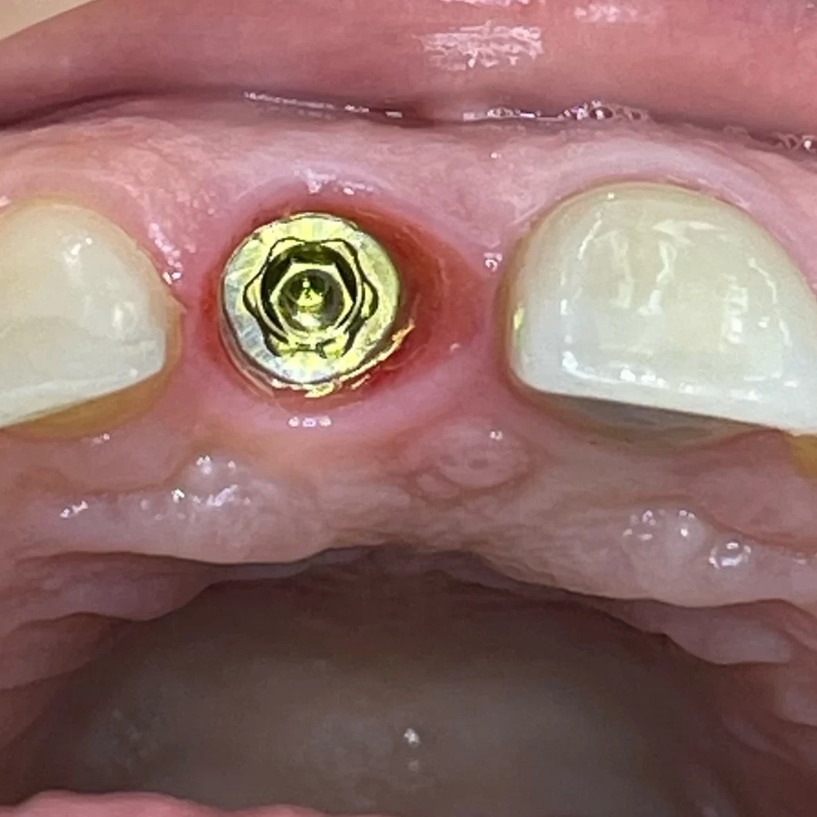 Azonnali implantáció