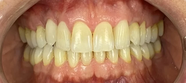 Szemfog implantáció után