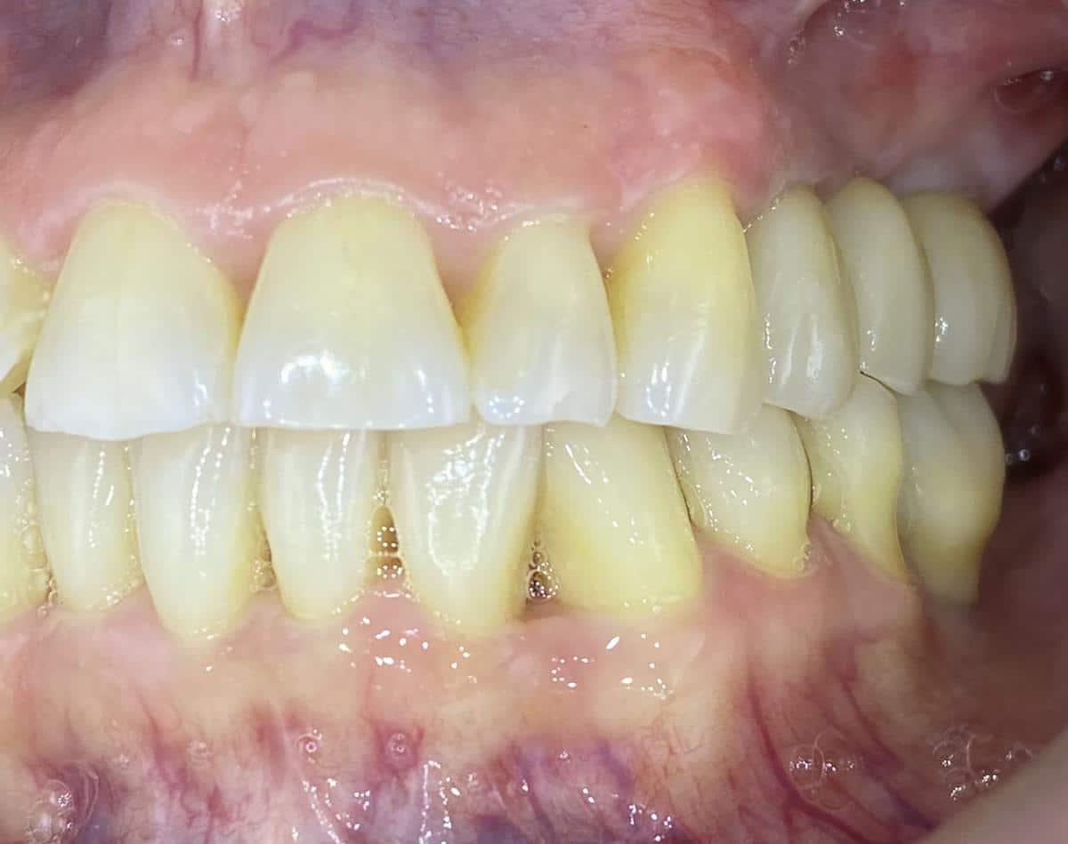 Oldalsó fogsak implantációs kezelése után