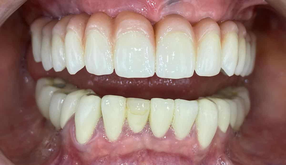Fogínygyulladás állapotában lévő fogsor, beavatkozás után, All-On-4 végleges implantátum