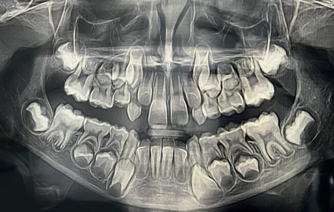 Fogváltás panoráma röntgen felvételen