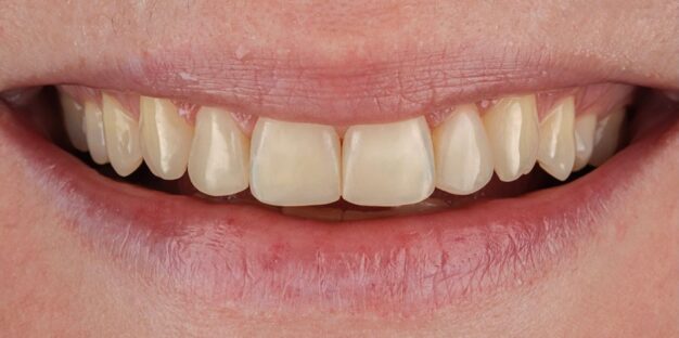 Esztétikai beavatkozás után