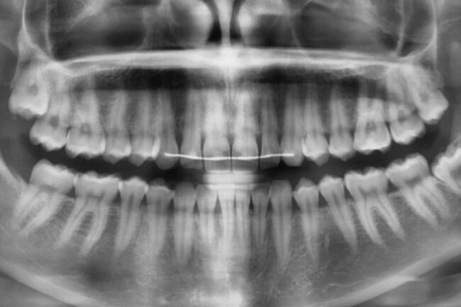 Intraorális röntgen