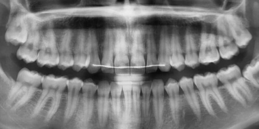 Intraorális röntgen